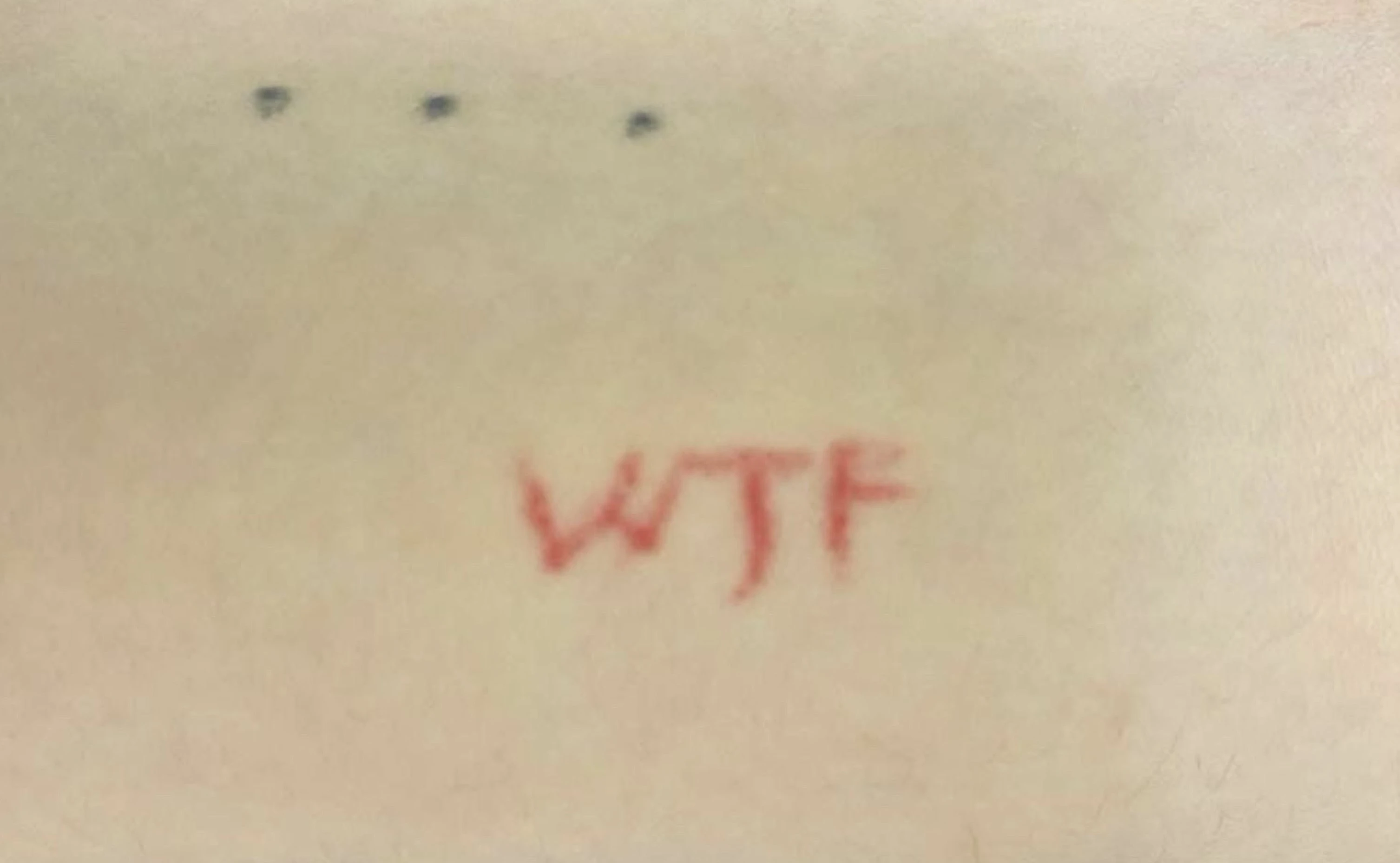 Antes - Eliminación de Tatuajes