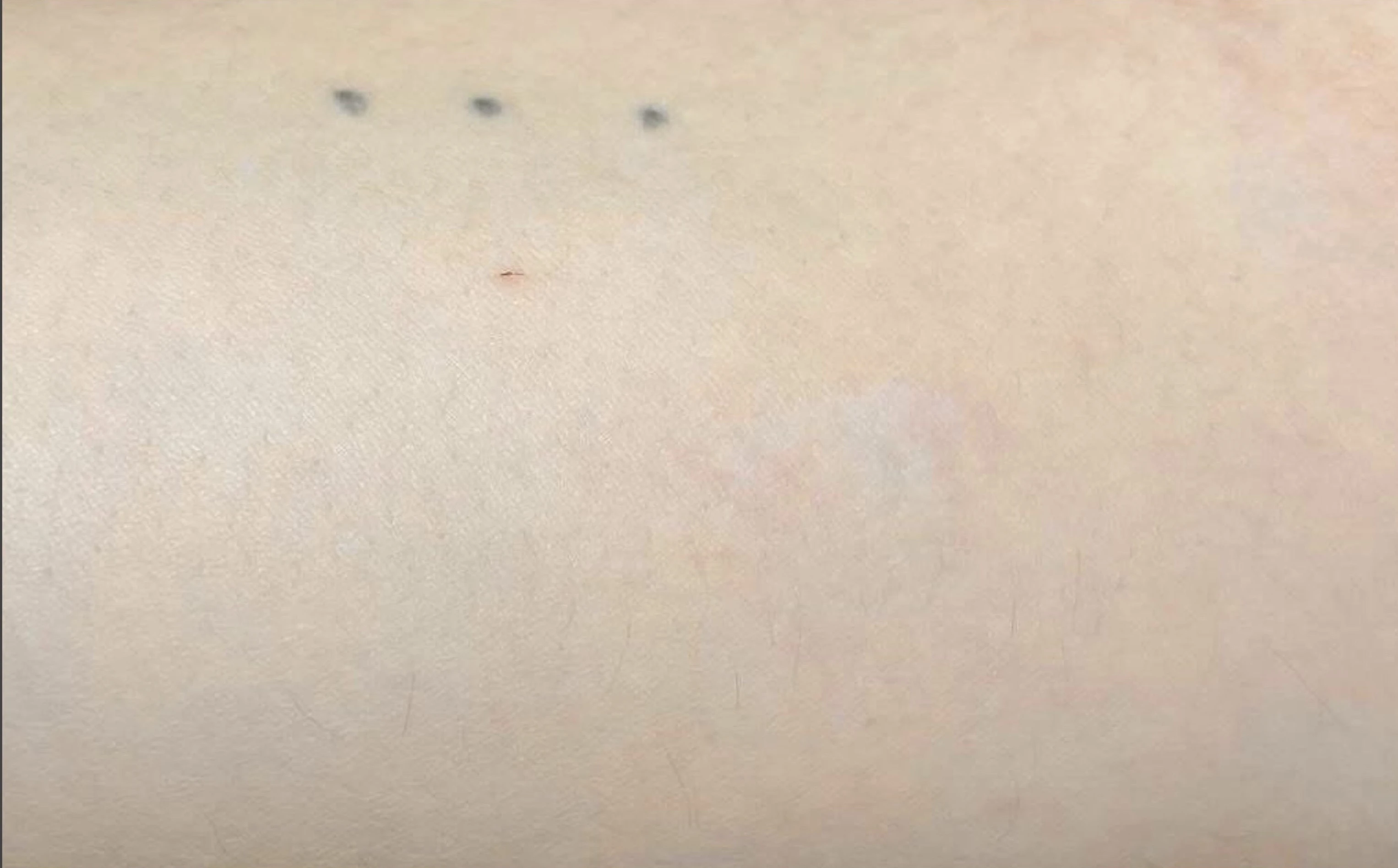 Después - Eliminación de Tatuajes