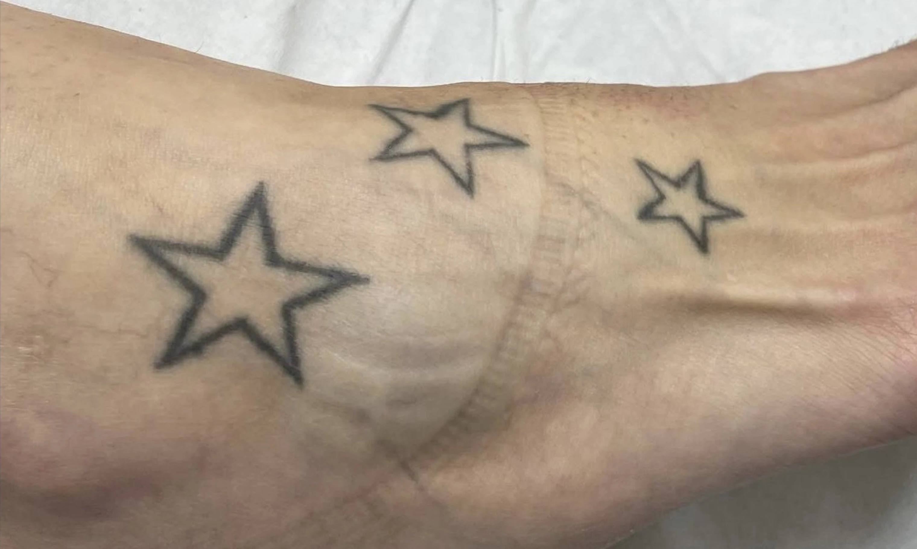 Antes - Eliminación de Tatuajes